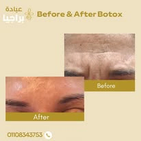 حقن البوتوكس لعلاج التجاعيد - عيادة براجيا للتجميل والليزر